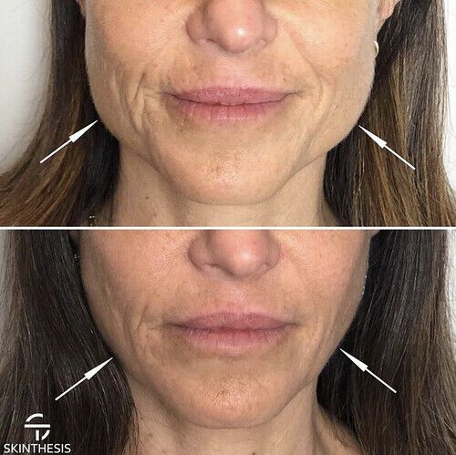 Facial Sleimming Botoxi ulevaade Kaalulangus 72 tunni jooksul